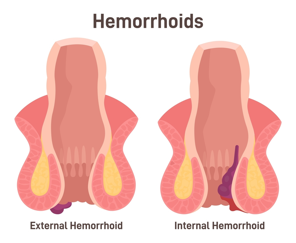 illustration of hemorrhoids